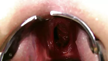 Prolapso kinkynikky xo speculum anal vídeo pornô anão